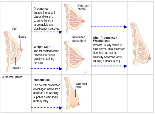 Why Do Breasts Sag?